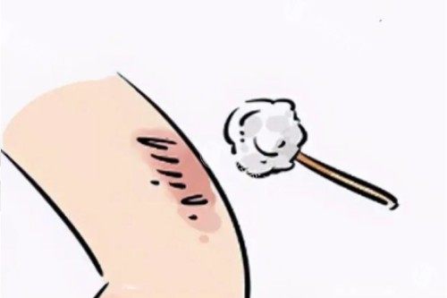 重庆杨东运医生疤痕修复大揭秘！多项技术优势 + 真实实例见证优异结果