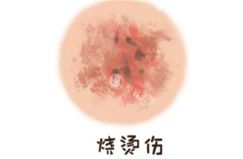烧烫伤疤痕