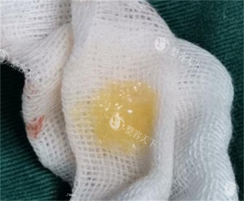 生长因子刚刚注射后取出的样子