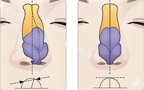 歪鼻矫正术对比图