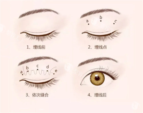 西安徐文云修复重度失败双眼皮实例：术前术后对比图及改善过程全记录！