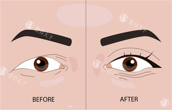 埋线双眼皮整形