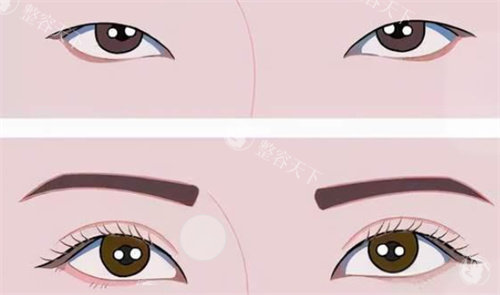 双眼皮前后对比