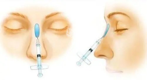 黛润plus属于什么档次？国产中高端档次玻尿酸，单支价格3000+性价比高