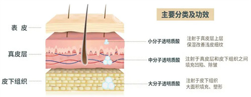 玻尿酸注射后皮肤变化