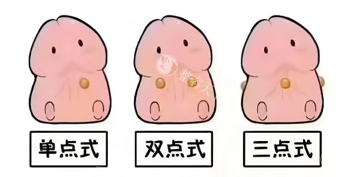 男士镶珠手术不是骗局！来看正规医院做镶珠手术全过程、价格、整友真实评价就知道