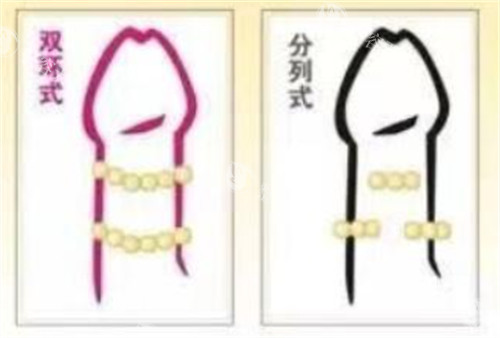 阴茎入珠术款式有哪些