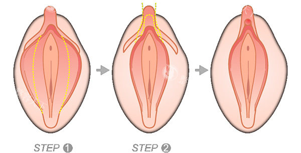 大阴唇手术怎么做