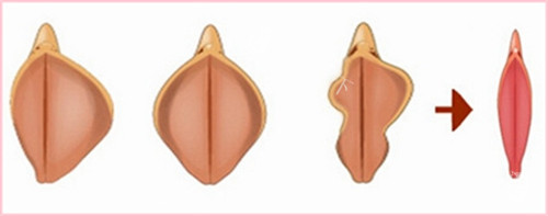 阴唇肥大和理想阴唇对比动画图