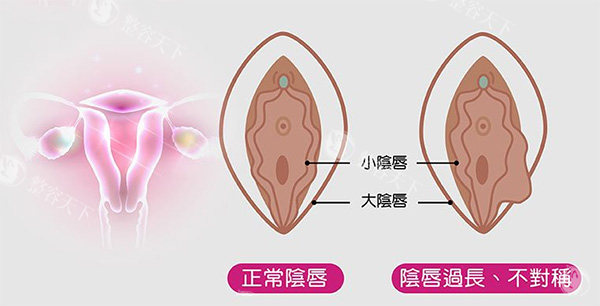 阴唇不对称改善照片