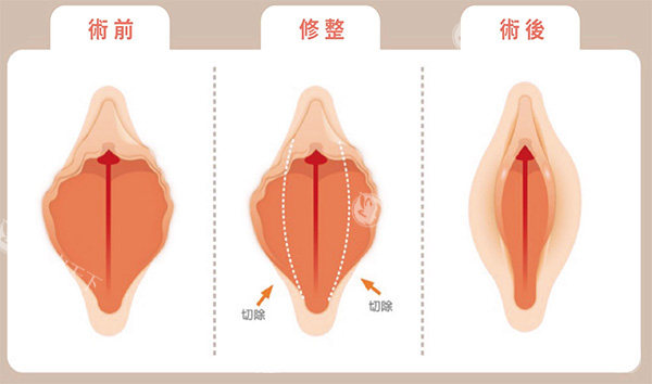 外阴唇切除术前术后