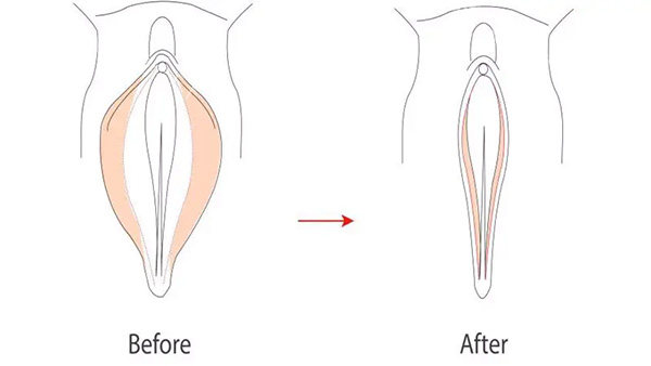 阴唇改善美观照片