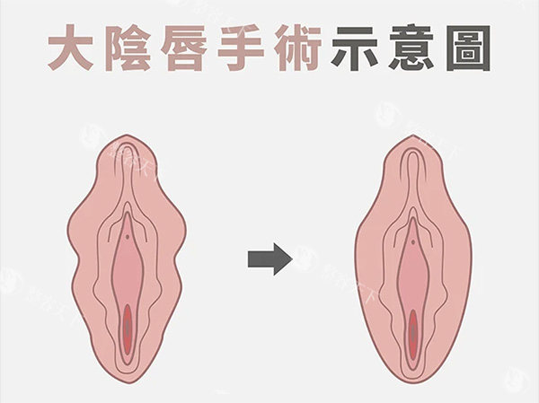 大阴唇整形前后照片