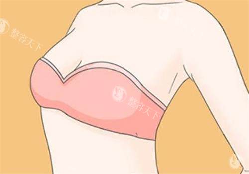 隆胸术后成效图