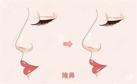 隆鼻术图