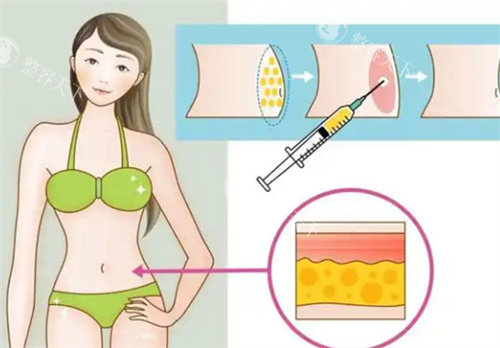 吸脂手术腰部