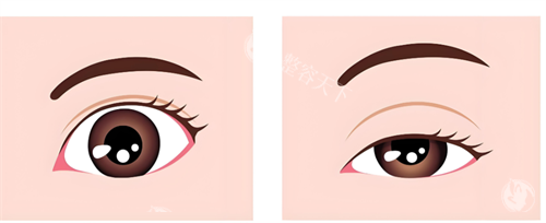 眼睛形态