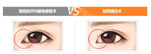 内眼角修复两种手术对比