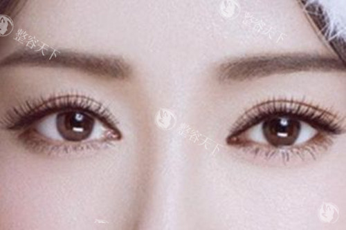 上海张楚双眼皮修复技术好在哪？三阶固定+筋膜移植，疑难眼型也能修