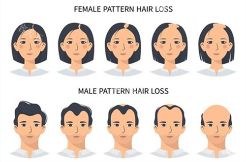 男女生发际线对比