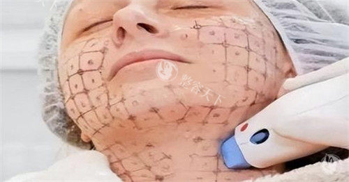 武汉同济医院热玛吉价格大公开！附上医生推荐和术后护理tips！