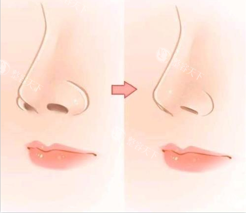 深圳做鼻翼缩小哪个医生好？李信锋|贺新强|邹奔|张辉|刘冰做鼻翼缩小0差评