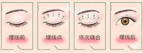 埋线双眼皮过程示意图片