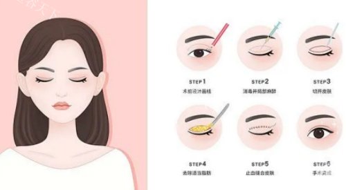 武汉谭琳双眼皮做得怎么样？16年经验+美杜莎技术+无痕缝合，修复肉条眼有一手，口碑太扎实！