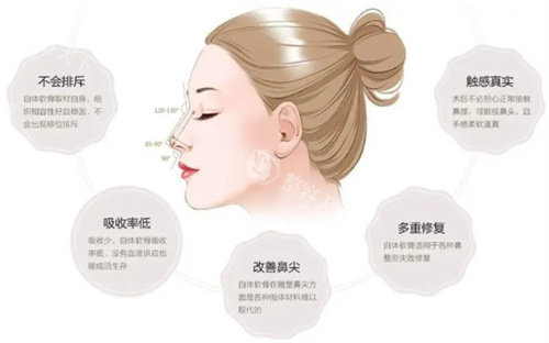 软骨隆鼻的优势