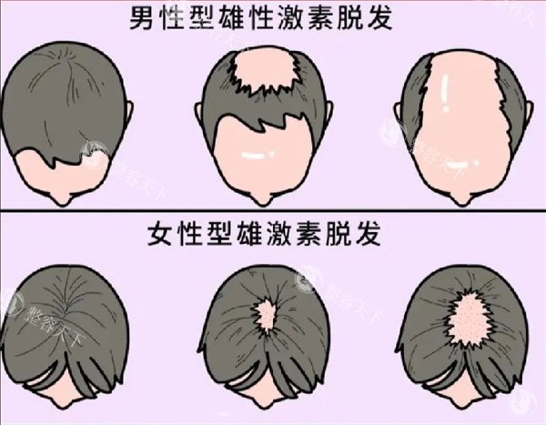 脱发图片
