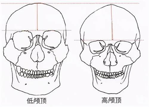 高颅顶和低颅顶的区别