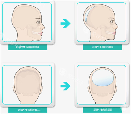 后脑勺填充过程