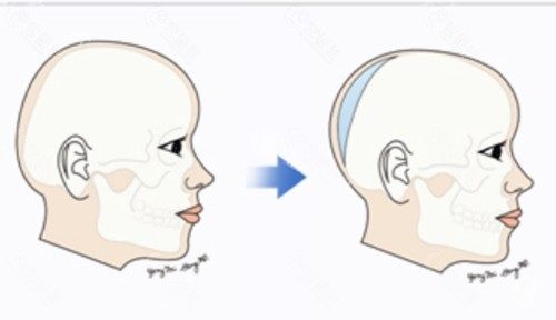 骨水泥填充后脑勺