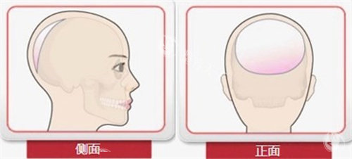 后脑勺整形手术