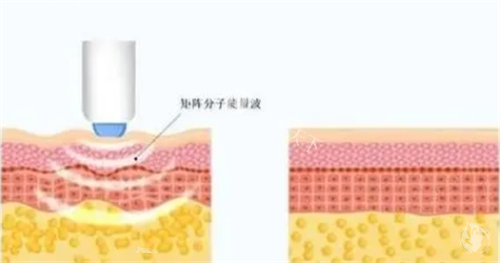 热玛吉项目皮肤剖面图