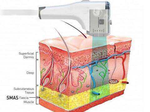 超声提拉操作原理