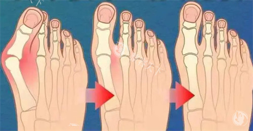 不同程度的大脚骨