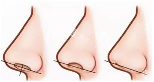 鼻翼缘退缩矫正多少钱？2025新价格表公开，8800元起至68000元左右