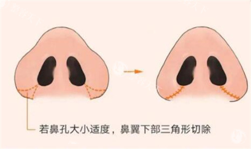 鼻翼缩小改善照片