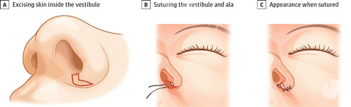 鼻翼手术前后对比图
