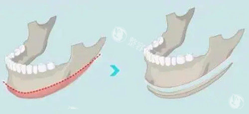 高俊明医生长曲线下颌角磨骨手术超棒！轮廓流畅自然，切口隐蔽，术后显高端