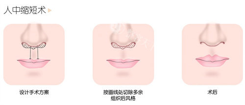 人中缩短术