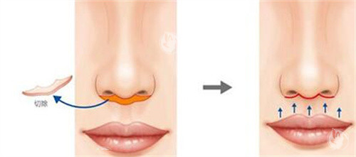 人中缩短改善卡通图展示