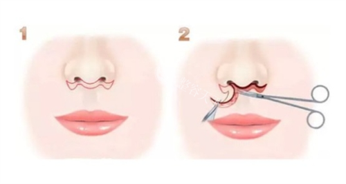 人中缩短术步骤过程