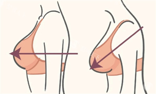 缩胸手术术前术后