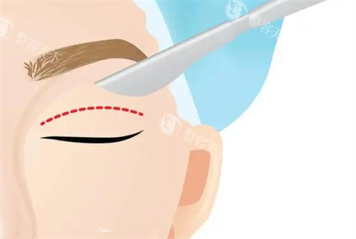 割双眼皮示意图
