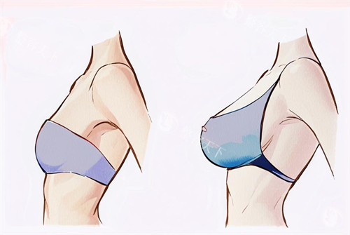 想要无痕美胸？揭秘假体隆胸腋窝、乳晕、下皱襞切口的优缺点！