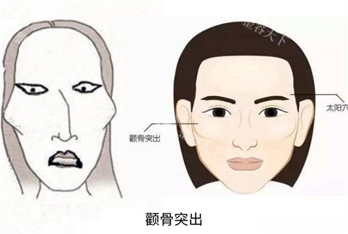 想了解颧骨内推老了会咋样看这里，术后感染、面部下垂等问题揭秘，早知早受益！