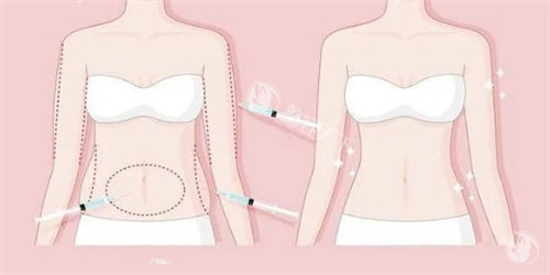 深圳万晓楠做3S人鱼体雕一次多少钱？2025价目表单部位1.58万起？多部位收费+隐藏成本全解析