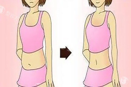 超脂塑体雕术与传统抽脂的区别是什么？纠结选体雕还是抽脂？看切口大小、修养时间、塑形精度！